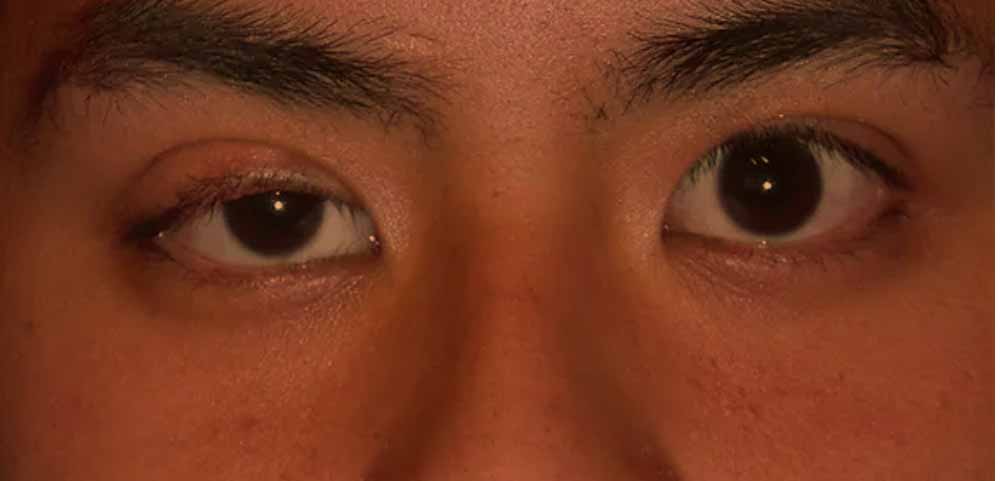 myasthenia-symptom